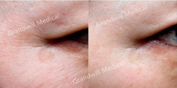 مواد مختلفة من حشو البولي كابرو لاكتون مواد مختلفة من حشو البولي كابرو لاكتون