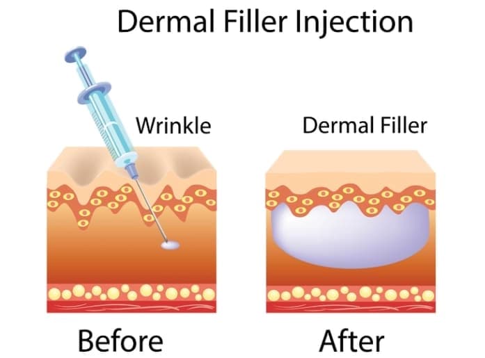 مقدمة عن حشوات الشفاه مقدمة عن حشوات الشفاه