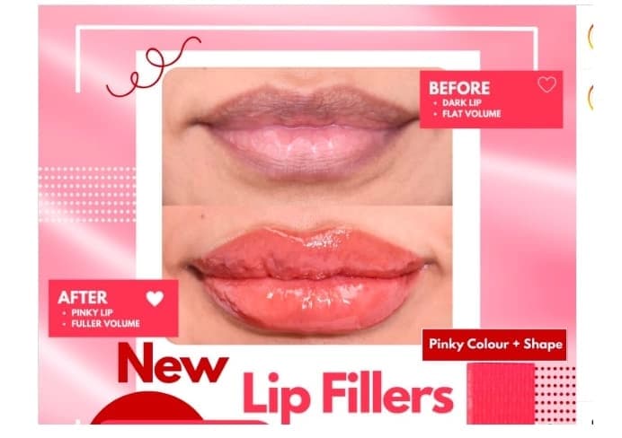 مقدمة عن حشوات الشفاه مقدمة عن حشوات الشفاه