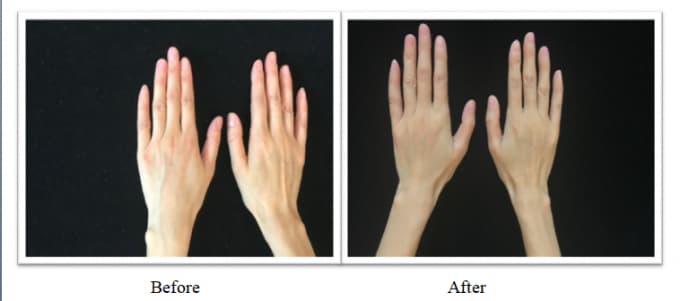 حشوة جلدية PLLA