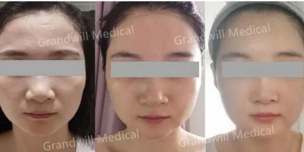 مواد مختلفة من حشو البولي كابرو لاكتون مواد مختلفة من حشو البولي كابرو لاكتون