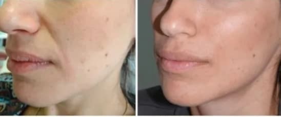 مزايا مادة هيدروكسي أباتيت الكالسيوم مزايا مادة هيدروكسي أباتيت الكالسيوم